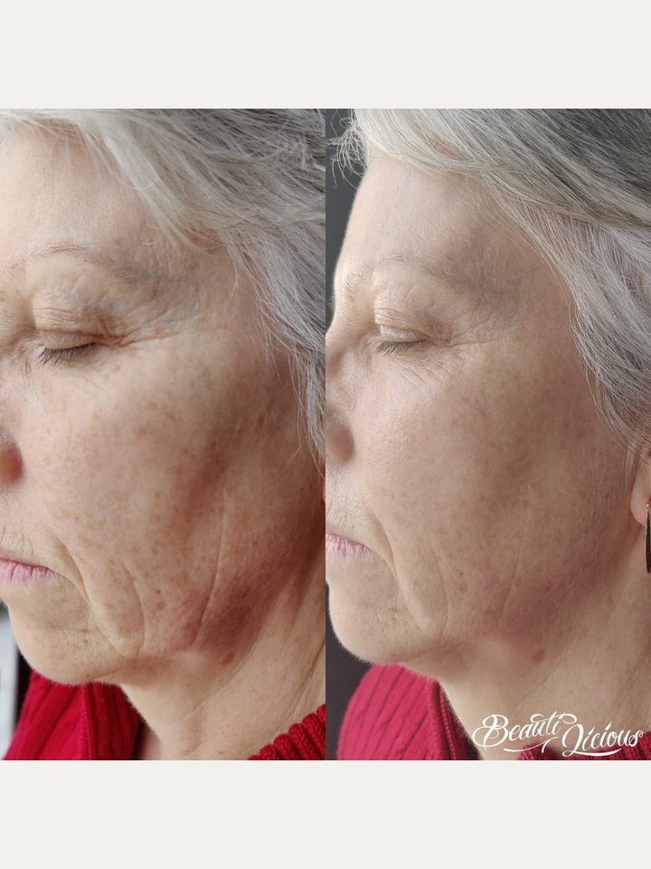 Skin treatment results at Beautilicious Beauty Salon